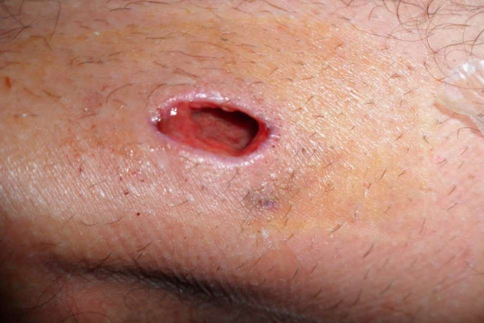 Effective Tips for Treating Ingrown Hair (Graphic Photos)